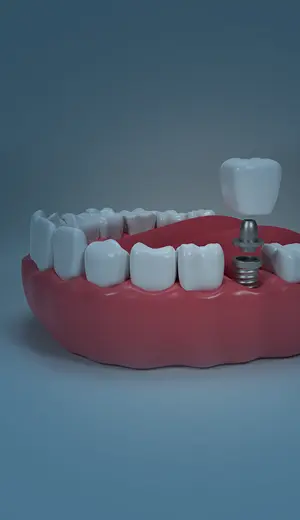 bone grafting & bone loss treatment (1)