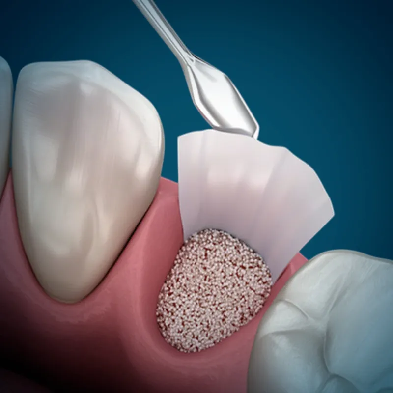 bone grafting