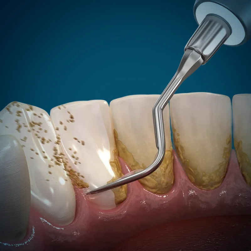 scaling and root planing