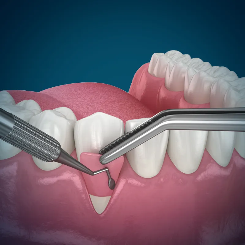 soft tissue procedure